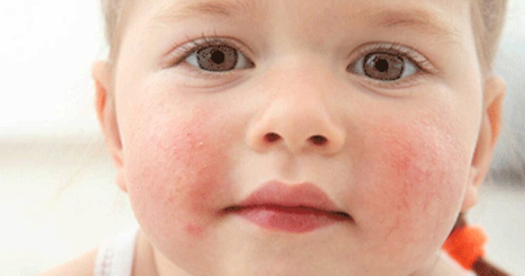 Cow Milk Protein Allergy