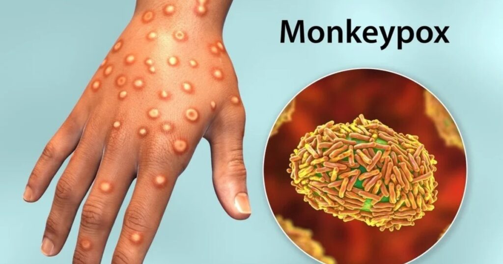 Monkeypox (Mpox)
