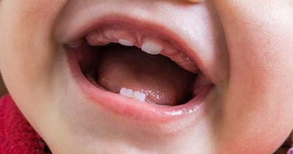 Natal and Neonatal teeth